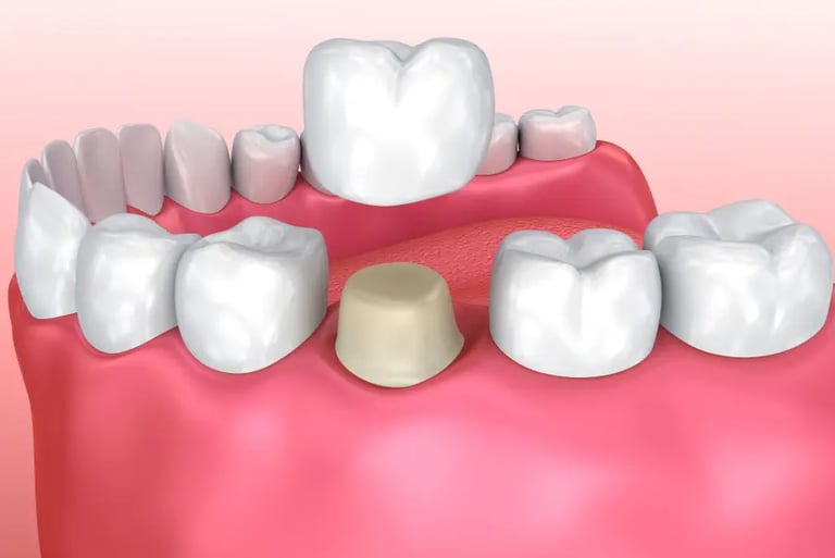 Diagram showing a ceramic dental crown being placed over a prepared tooth on the lower jaw.