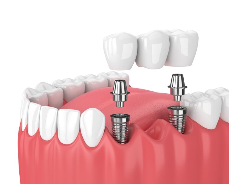A Dental implant bridge being placed onto titanium screws in a human jaw.